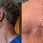 5 Fakta Exclusive Tentang Basal Cell Carcinoma yang Dialami Gordon Ramsay – Waspadai & Lindungi Kulit Anda