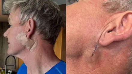 5 Fakta Exclusive Tentang Basal Cell Carcinoma yang Dialami Gordon Ramsay – Waspadai & Lindungi Kulit Anda