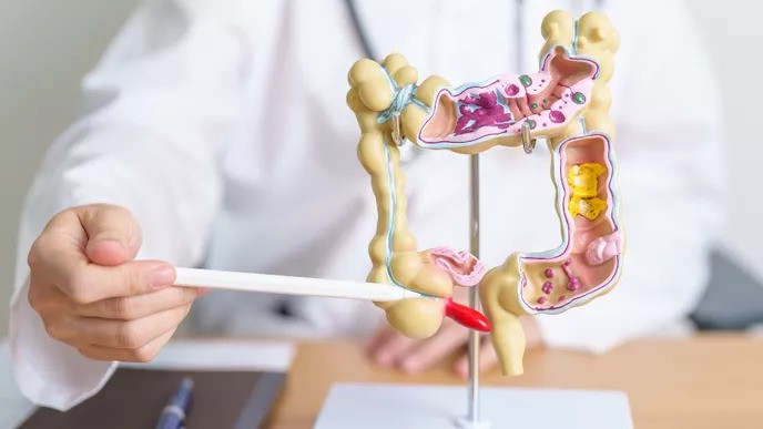 5 Fakta Exclusive – Fokus Risiko Kanker Usus pada Milenial dan Gen Z